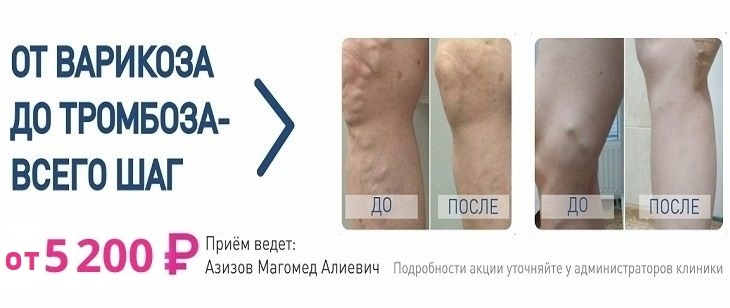 Склеротерапия по специальной цене: от 5 200р.