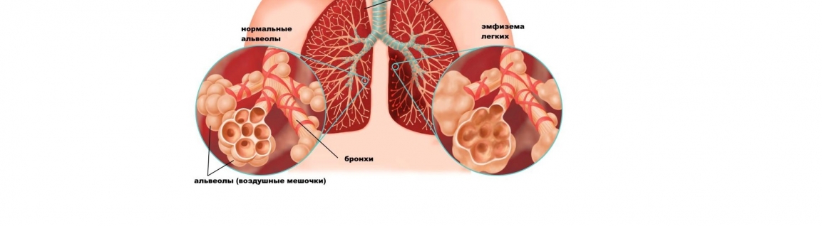 Эмфизема легких: причины, симптомы, диагностика и лечение