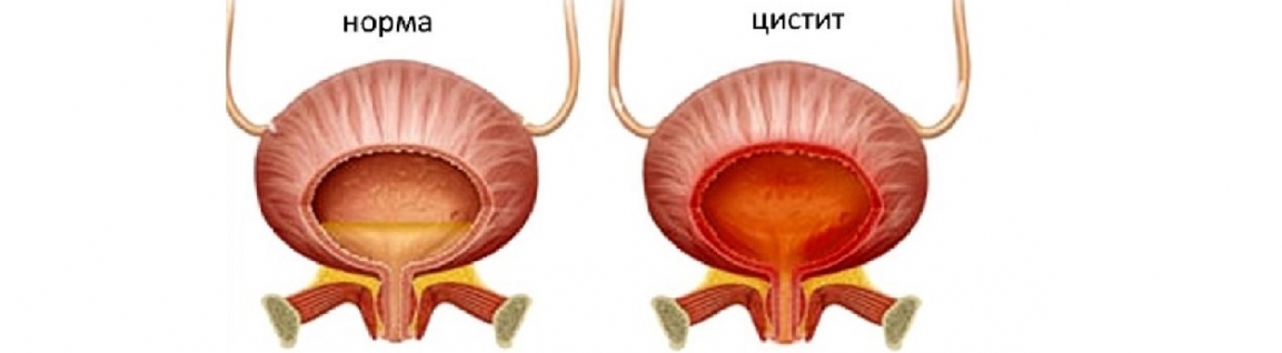 Цистит: причины, симптомы, диагностика и лечение