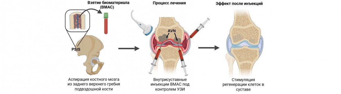 Что такое BMAC-терапия?